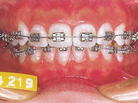 出っ歯　2期治療