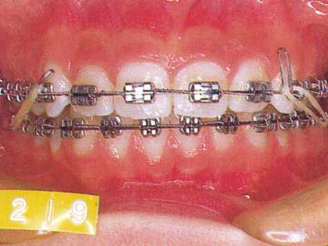 出っ歯　2期治療
