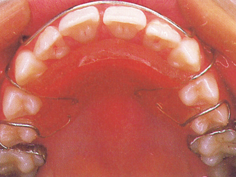 出っ歯　1期治療