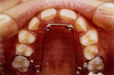 上顎 拡大 装置